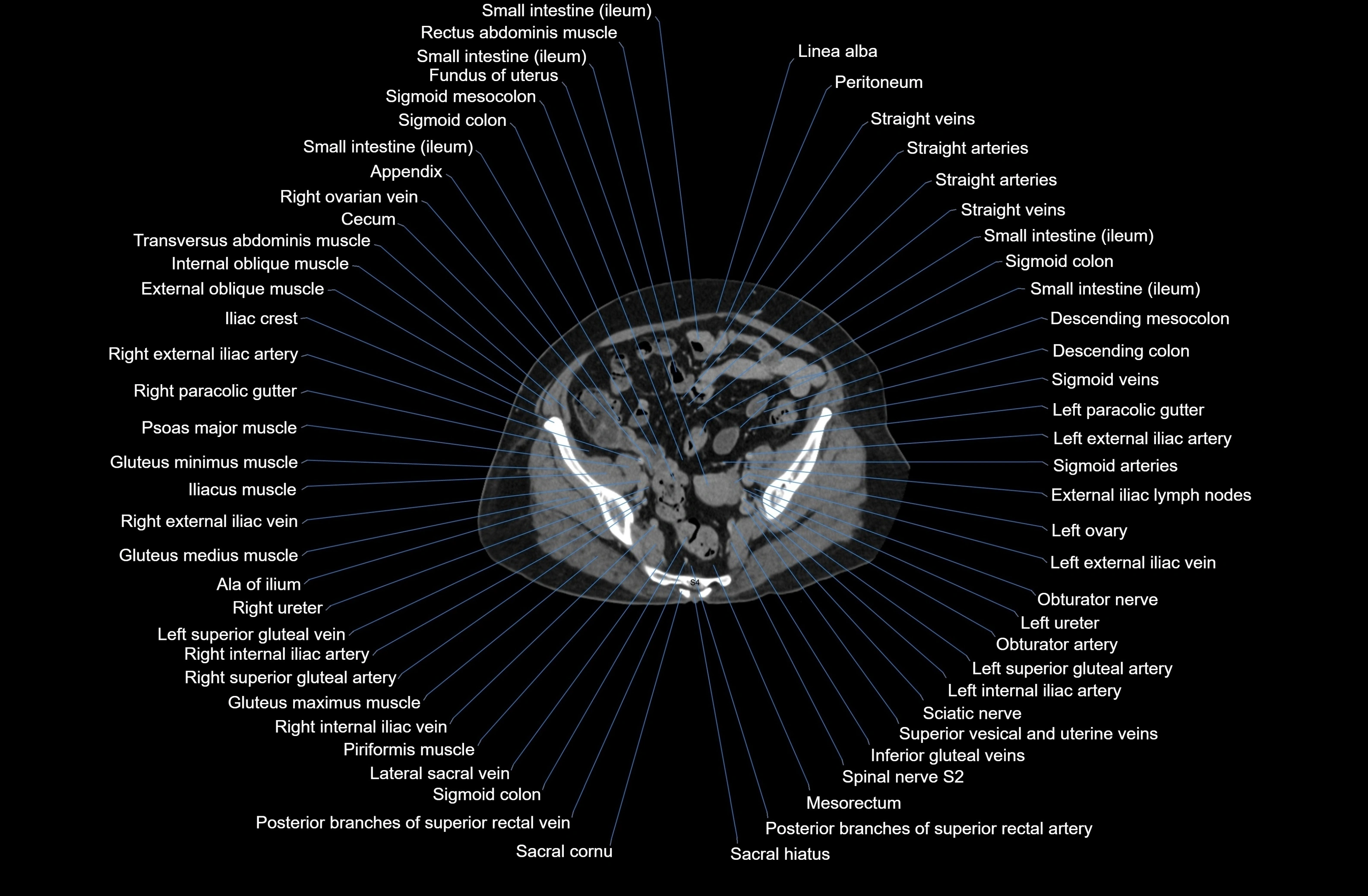 CT Abdomen axial cross sectional anatomy labelled radiology image-00076.webp